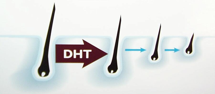 DHT脱发