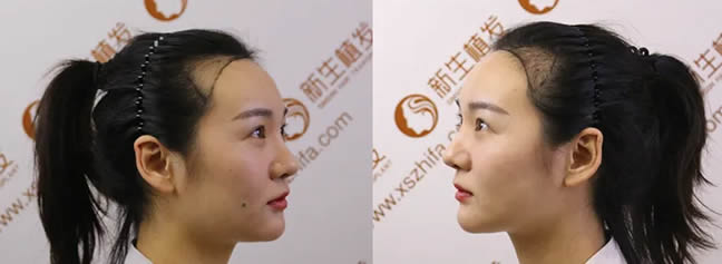新生植发李女士植发案例