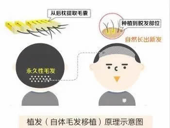 植发手术的原理