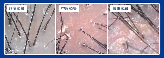 头皮油脂分泌图