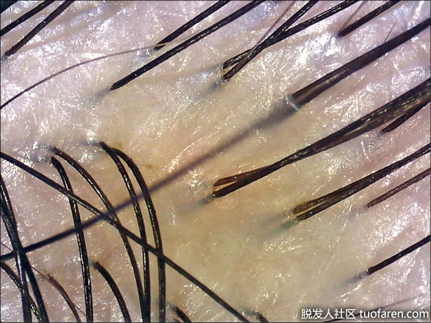 正常头皮无皮屑、无发红
