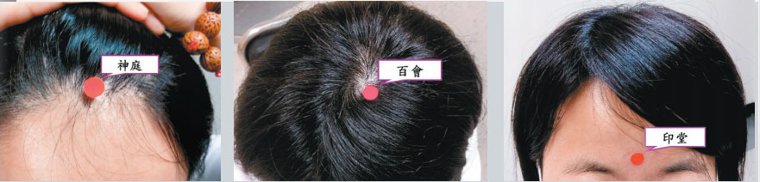 百会穴、印堂穴和神廷穴