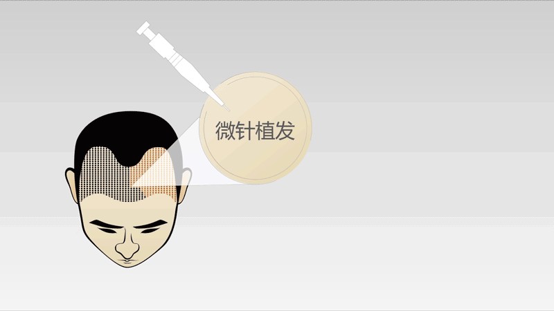 大麦微针植发动态示意图