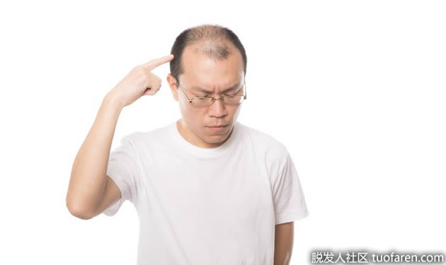 AGA雄性脱发很难及早发现