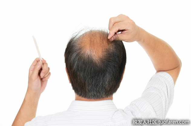 脱发的类型